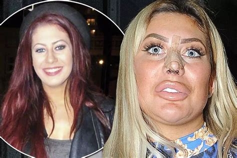 chloe geordie shore before and after surgery|chloe ferry scarring.